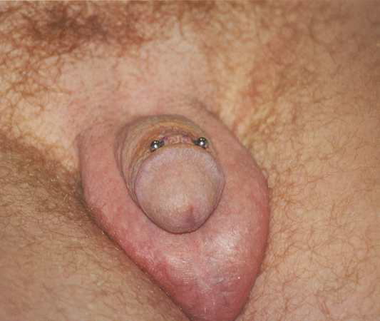  the shaft of the penis. Considered a relatively easy . frenum piercing